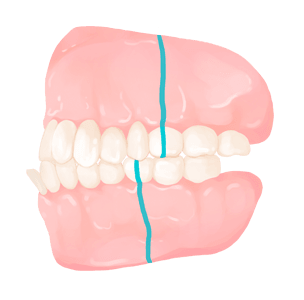 부정교합(malocclusion)’은 여기에 반대되는 개념이라 생각하시면 됩니다.
